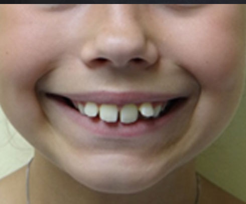 Smiling kid in tie with Braces