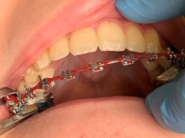 Starting With Braces  Orthodontist Sunbury, OH